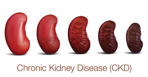 ckd news chanel|chronic kidney disease news.